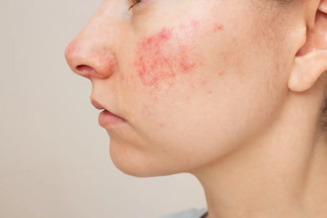 Rosacea